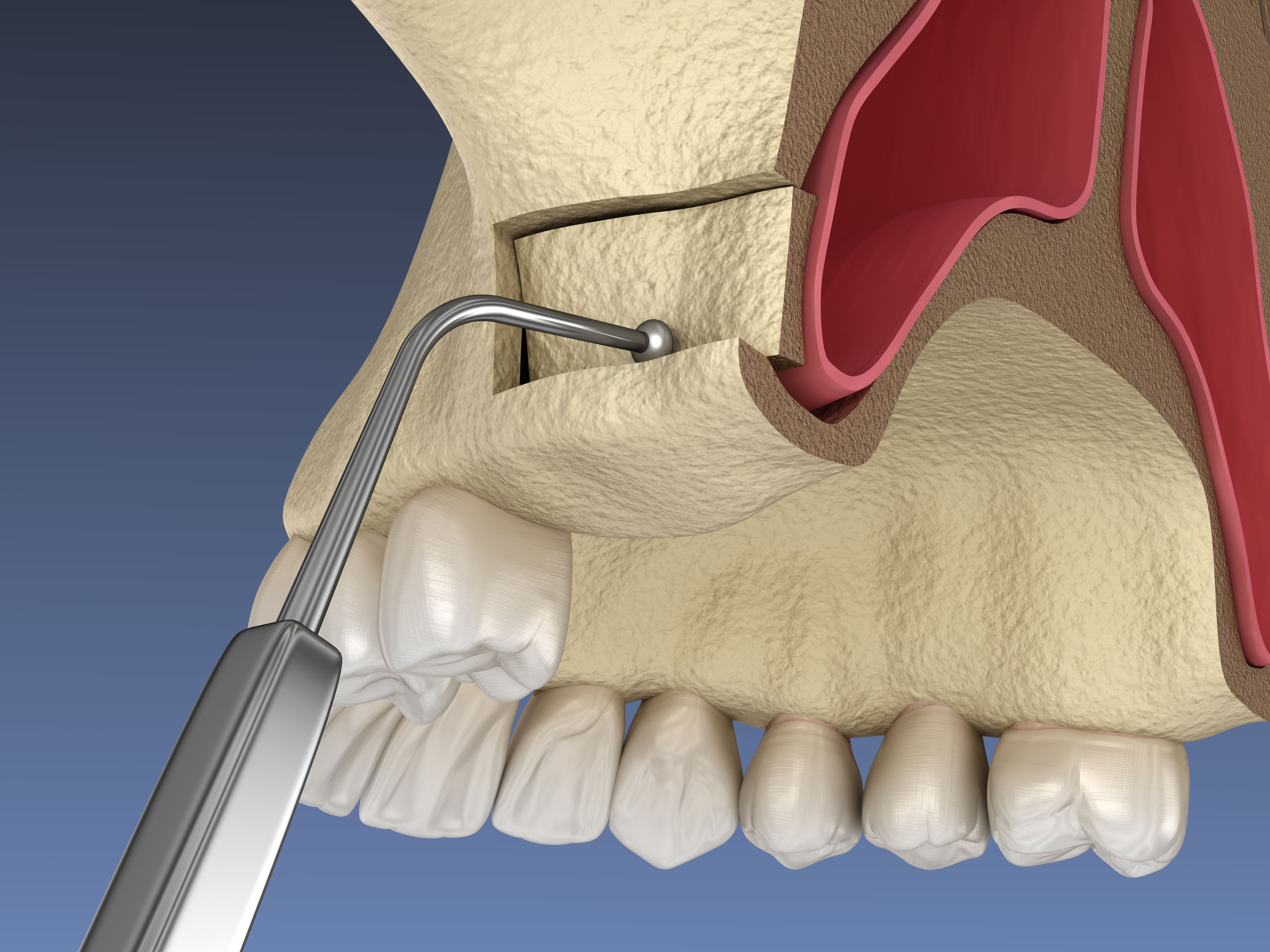implant