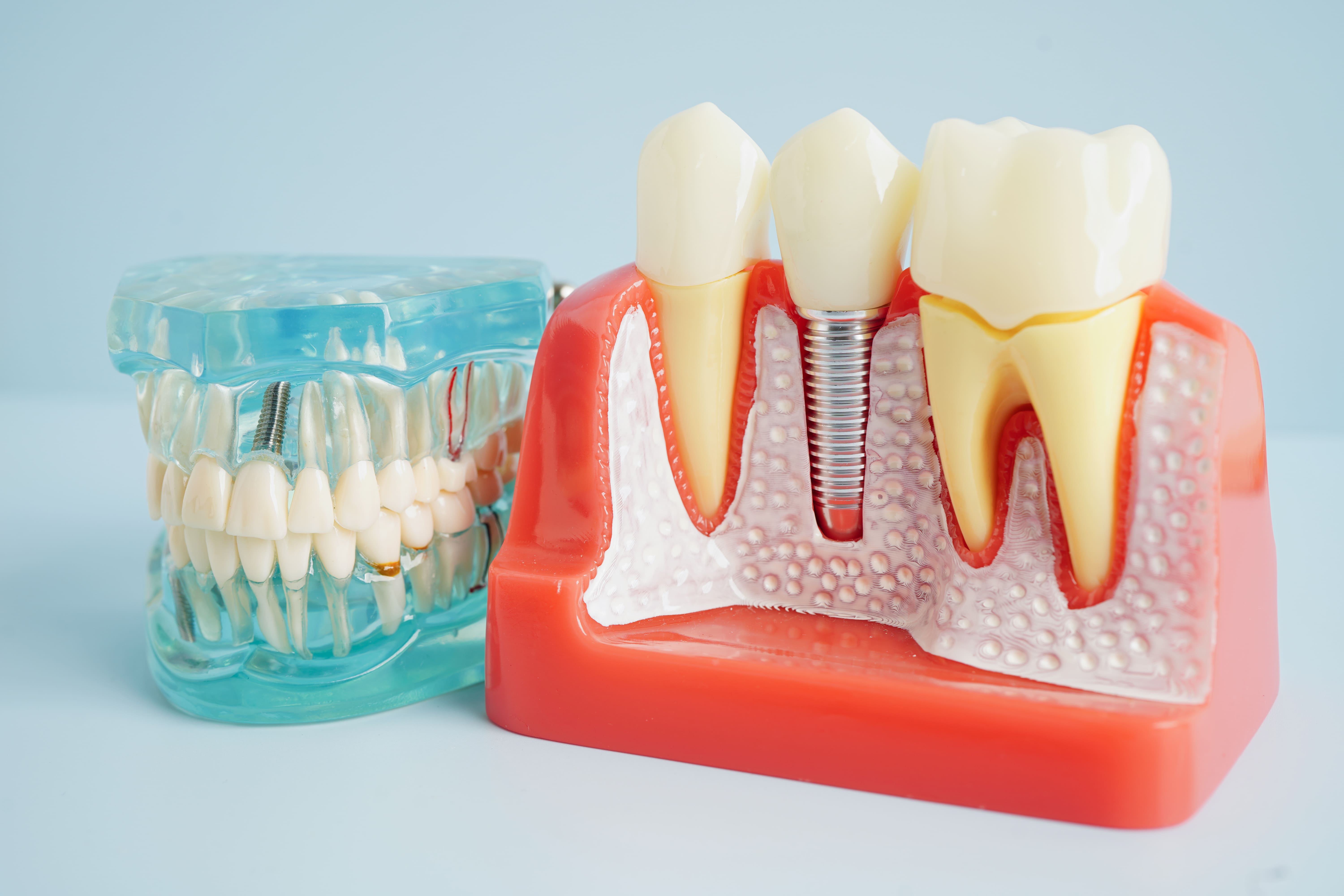 implant
