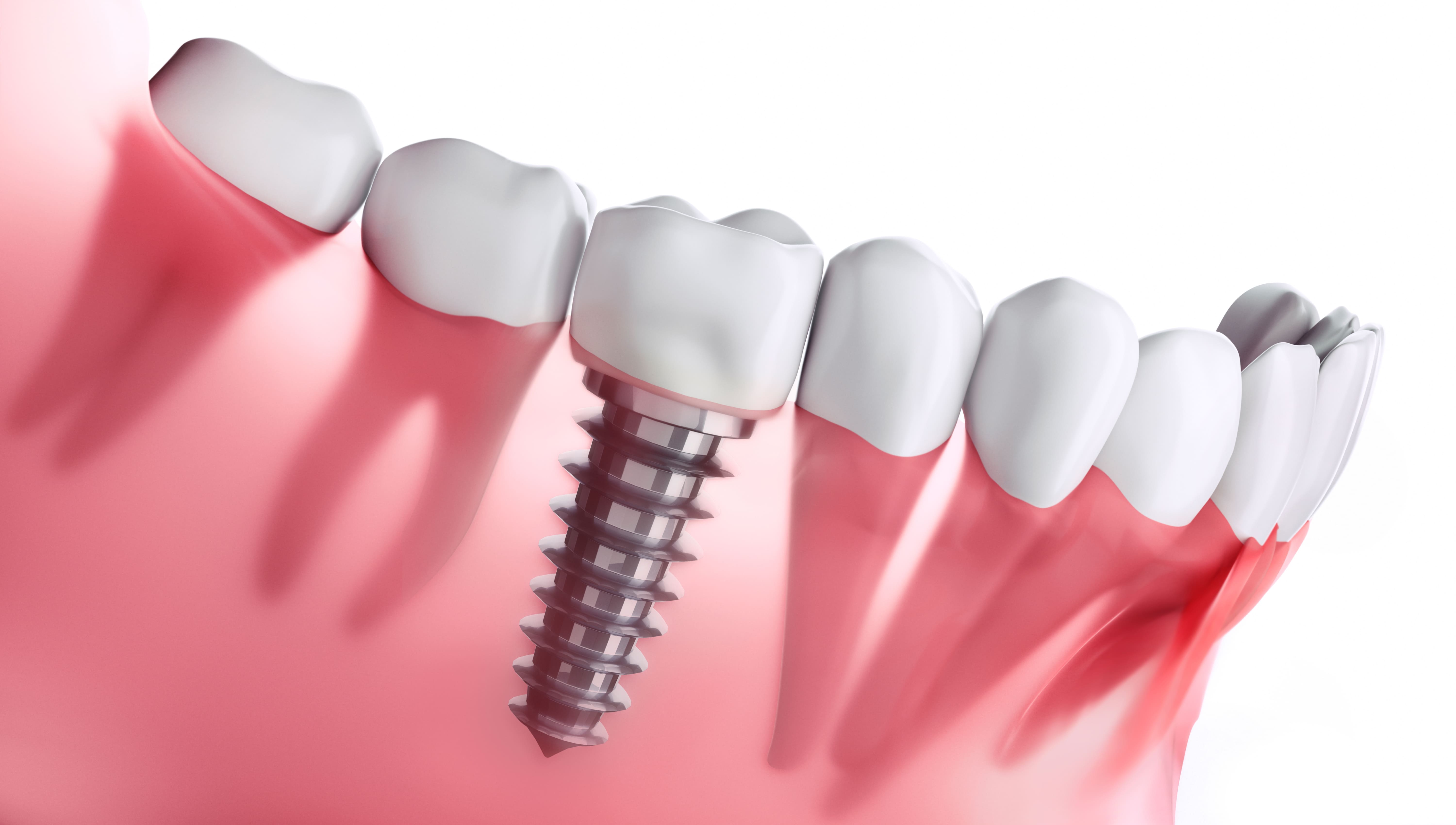 implant