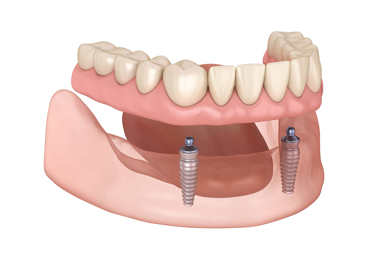 implant