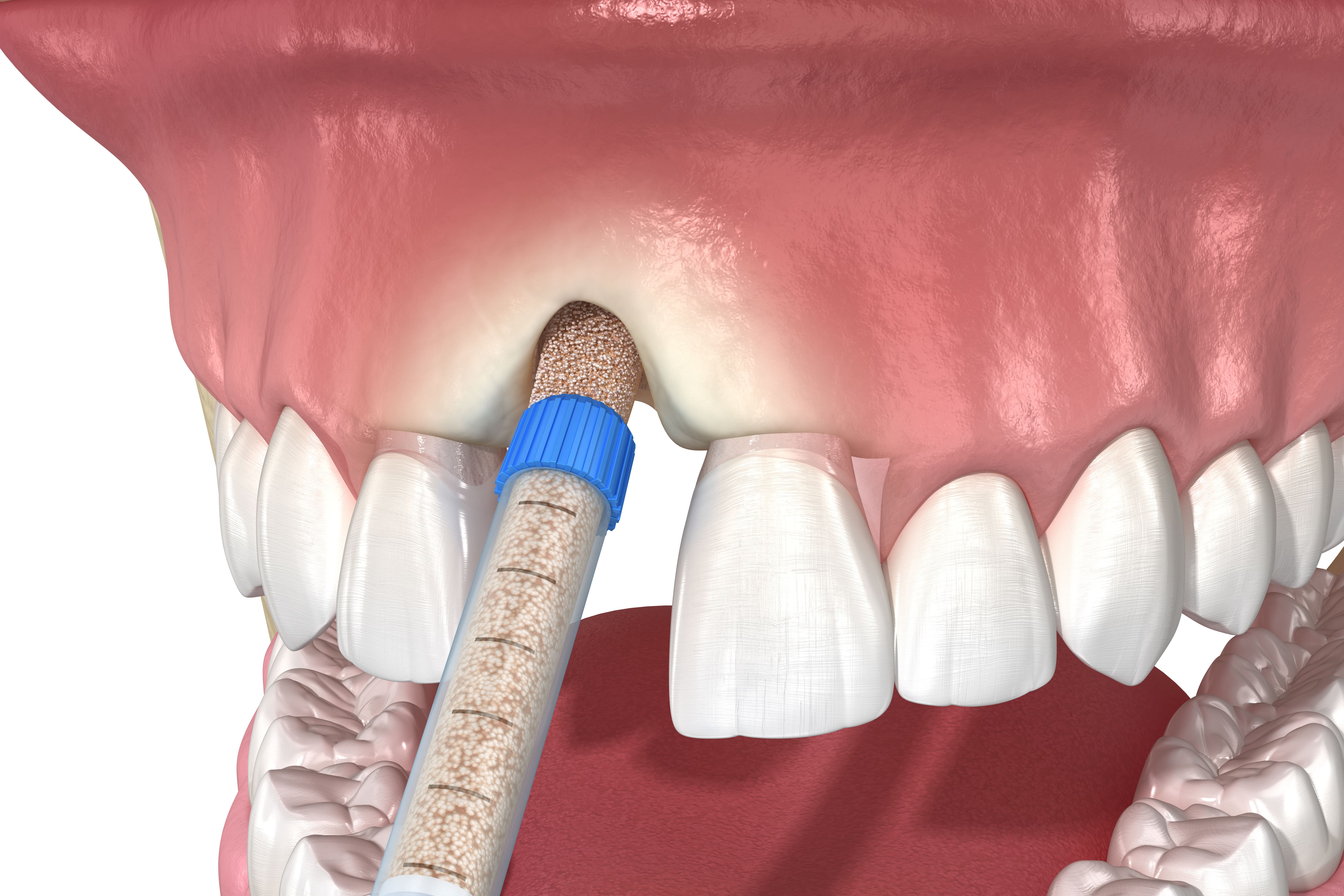 implant
