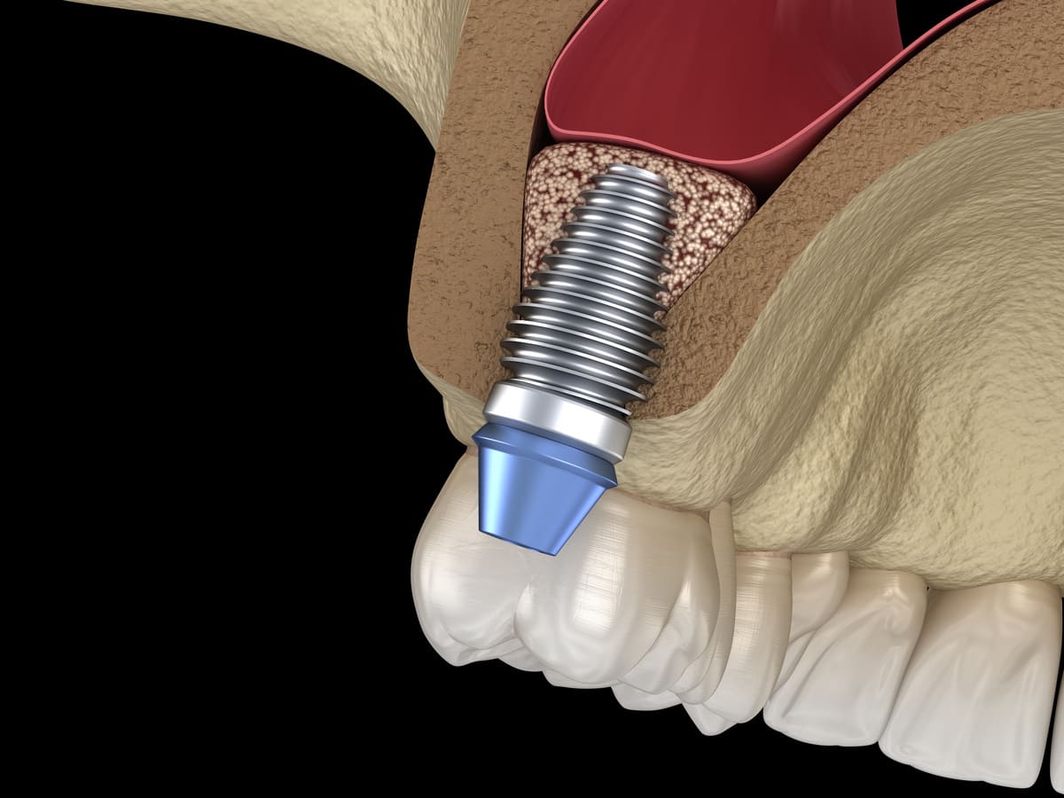 implant