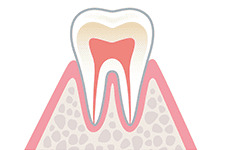 caries