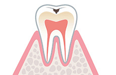 caries