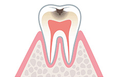 caries