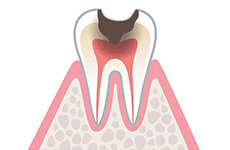 caries