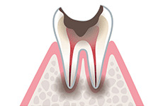caries
