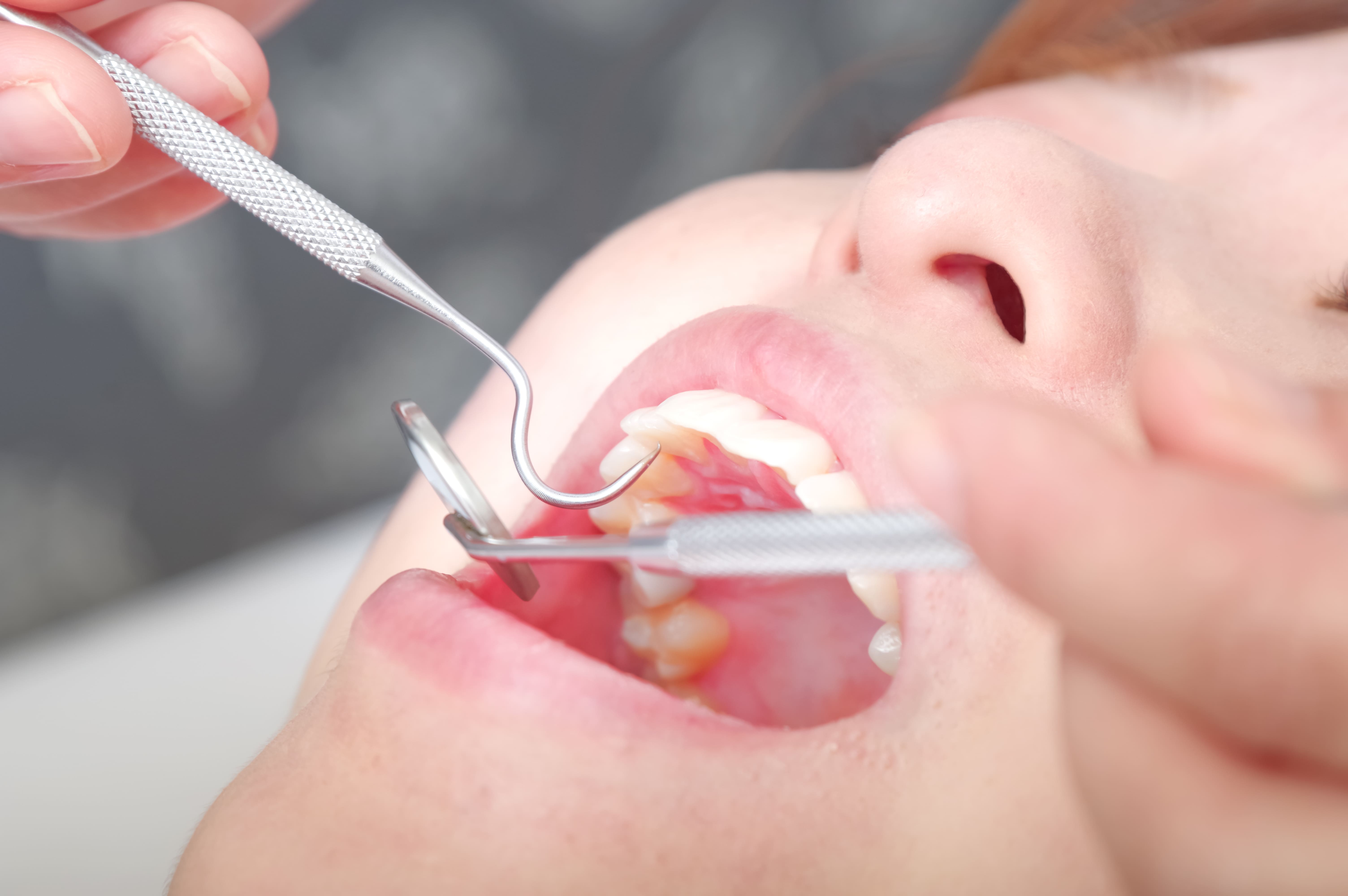caries
