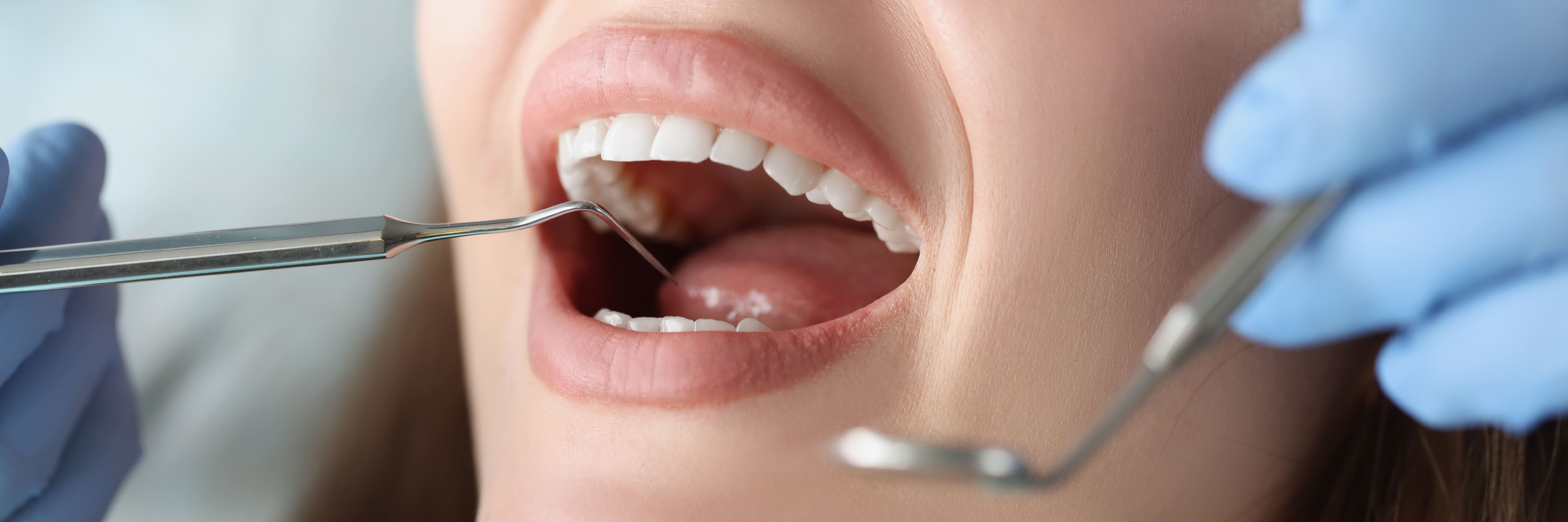 caries
