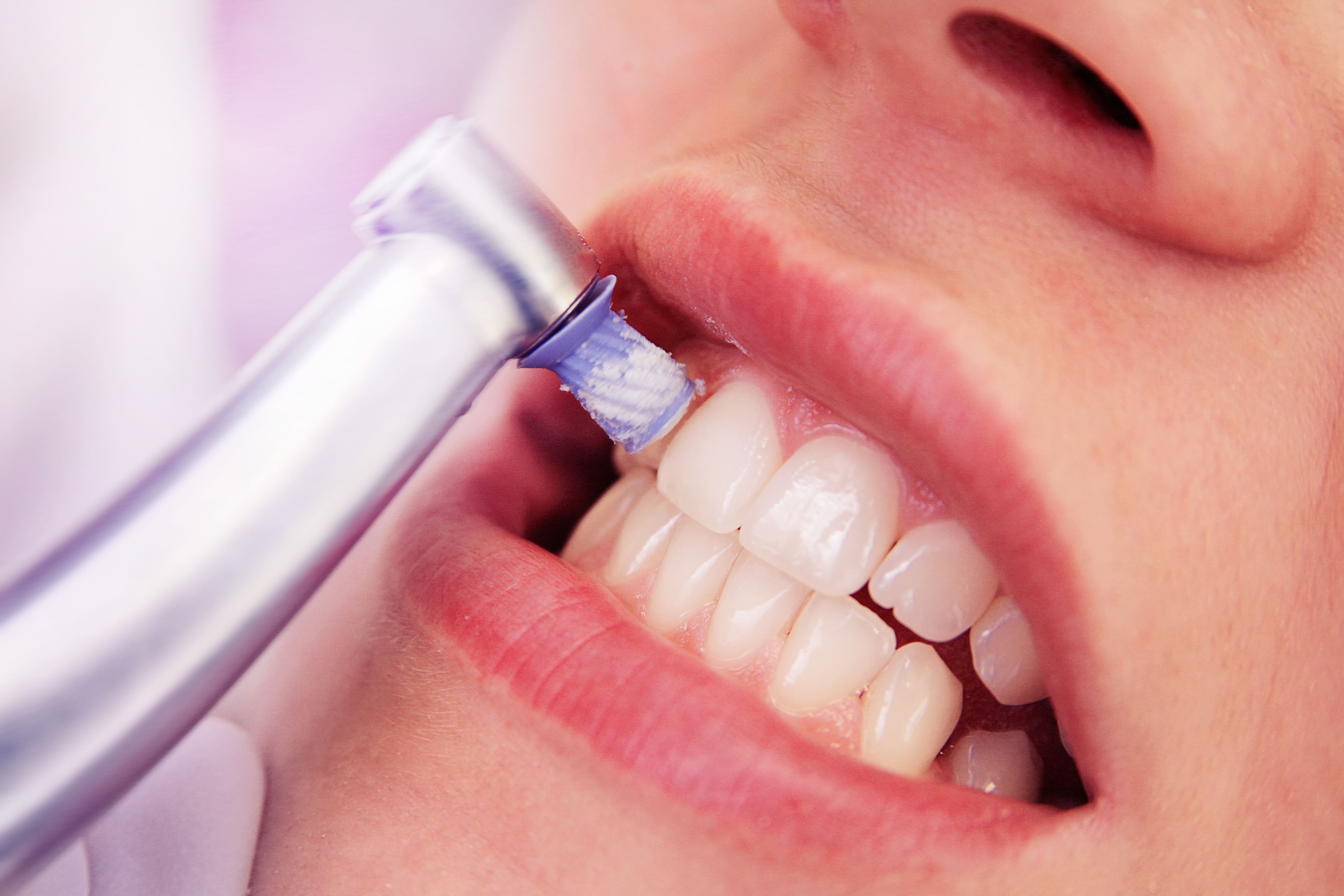 caries