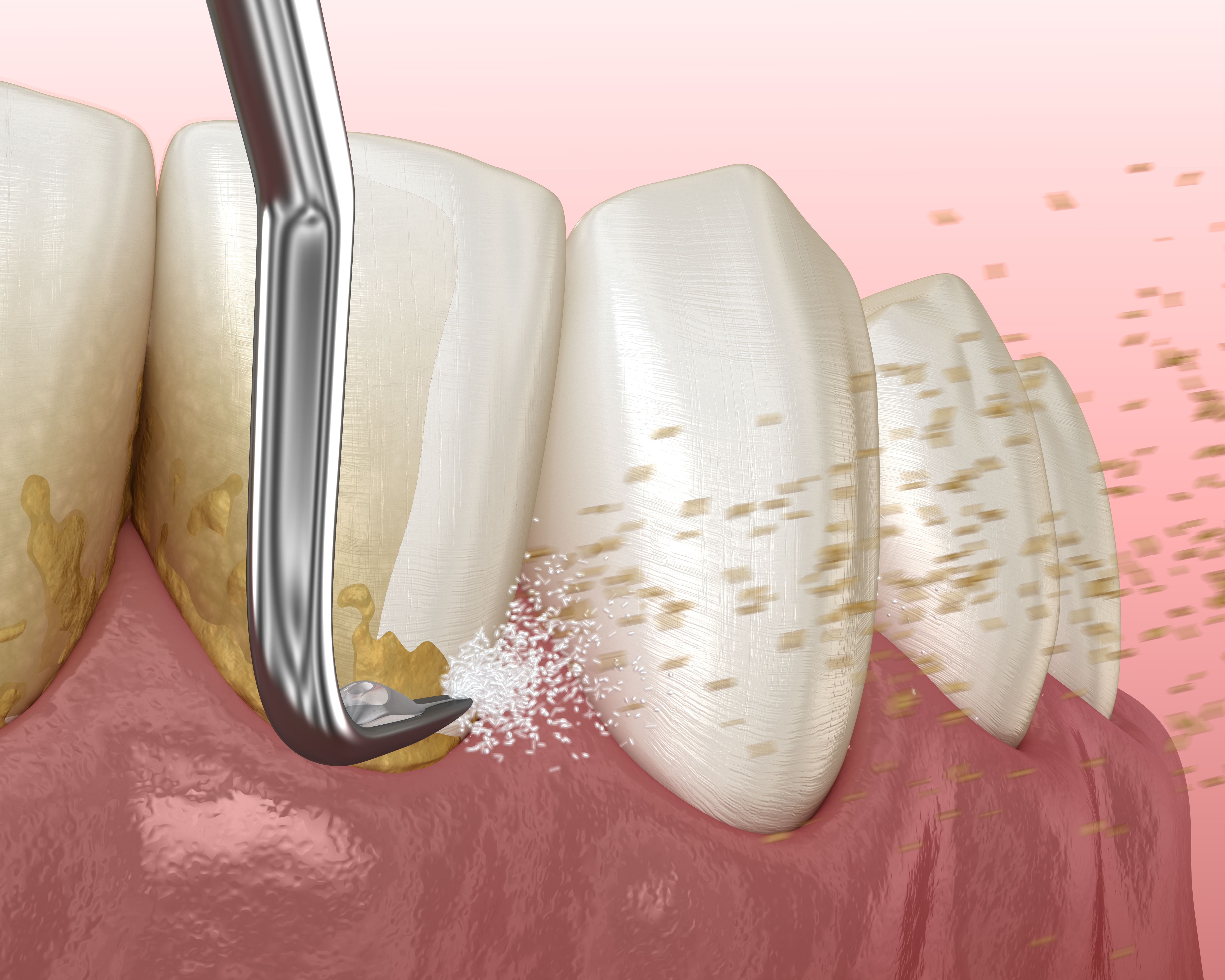 caries