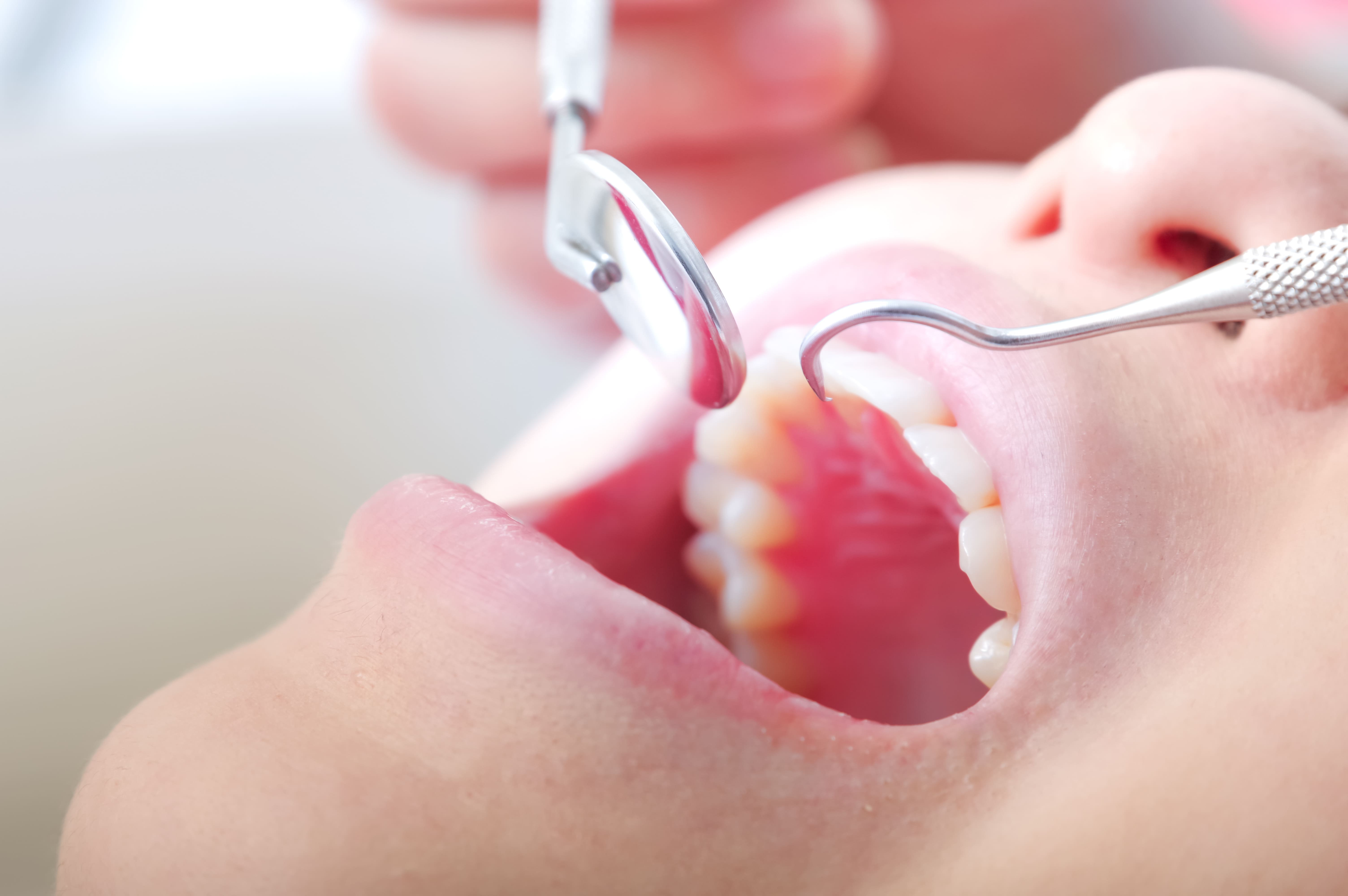 caries
