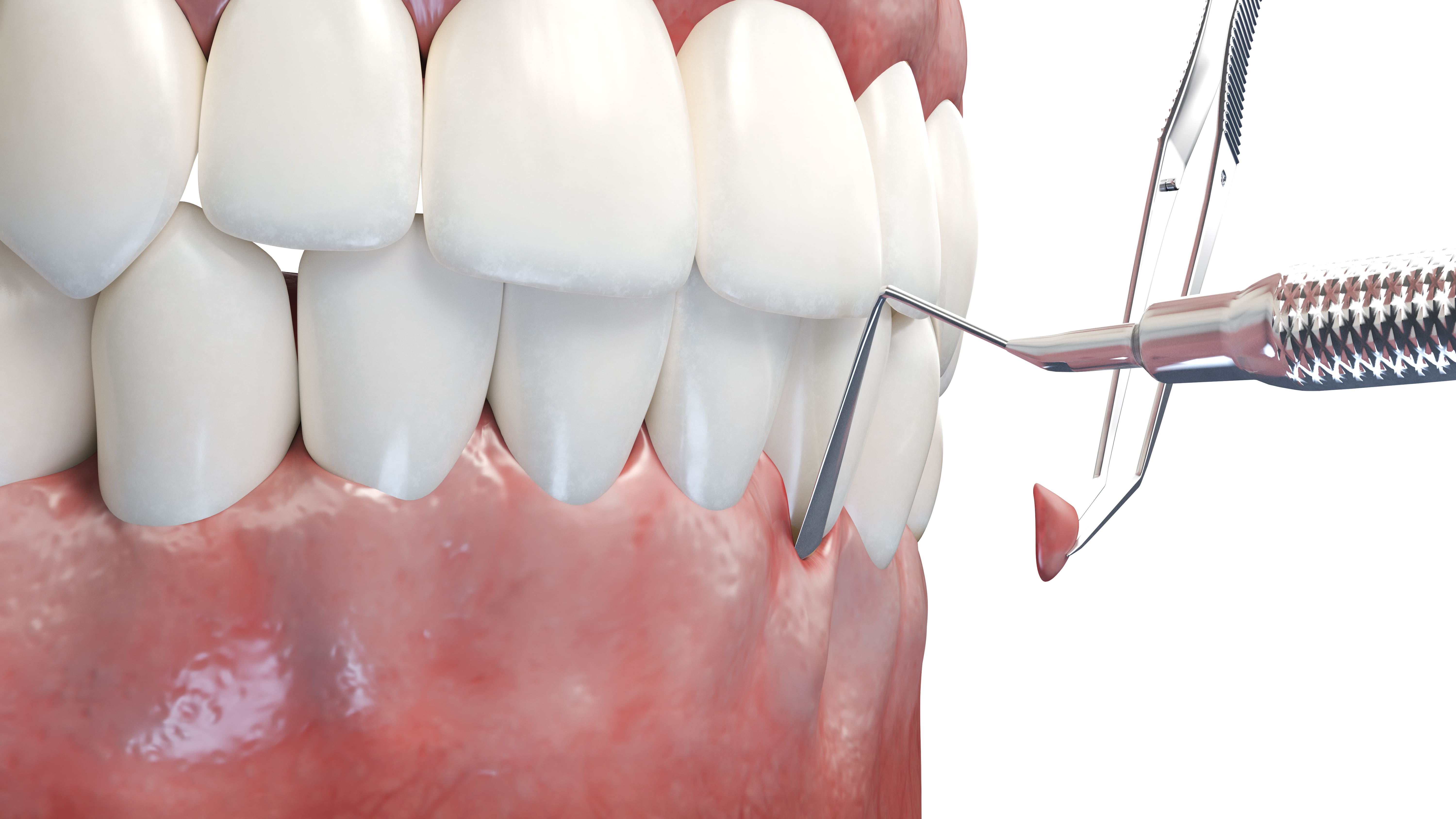 caries