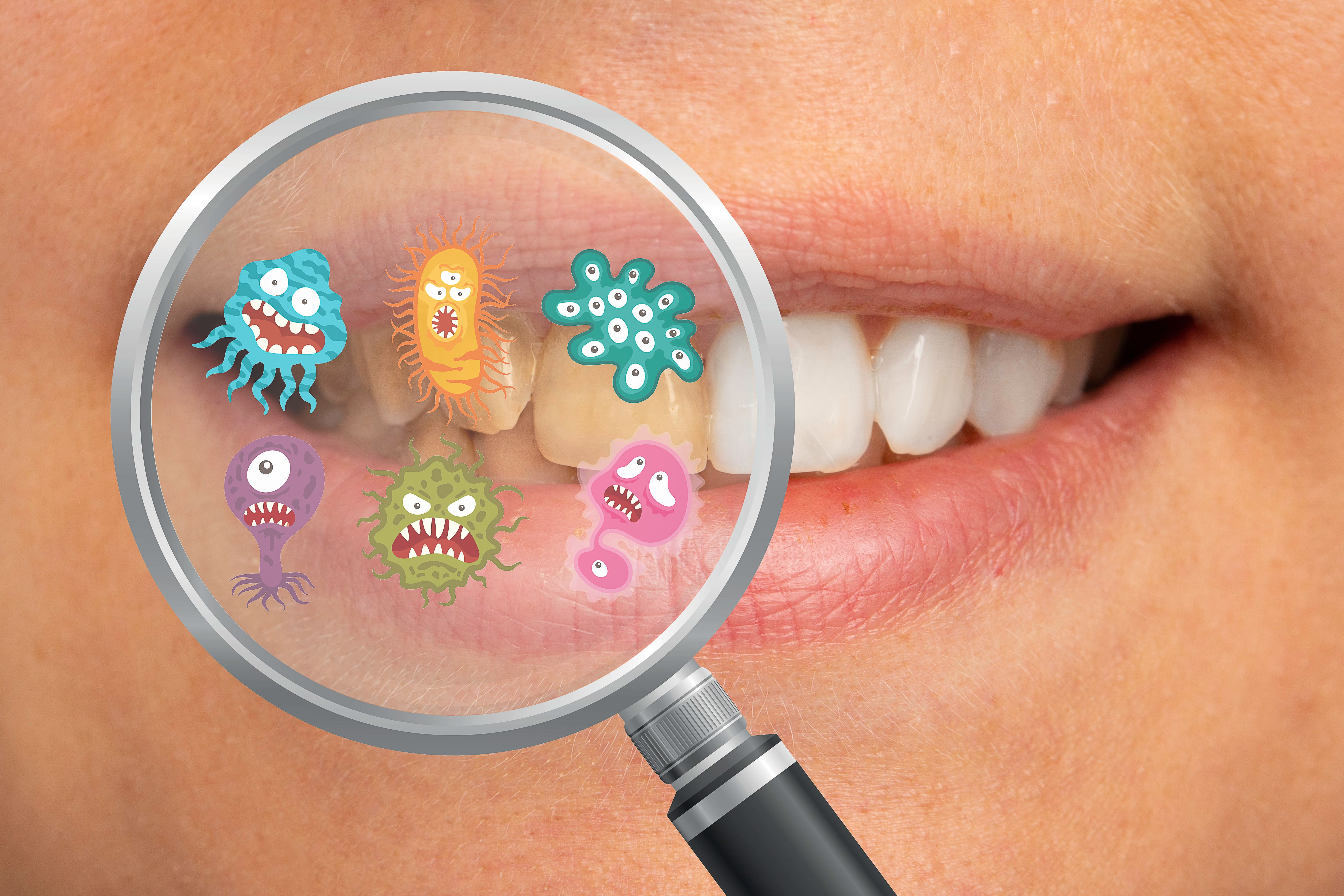 caries