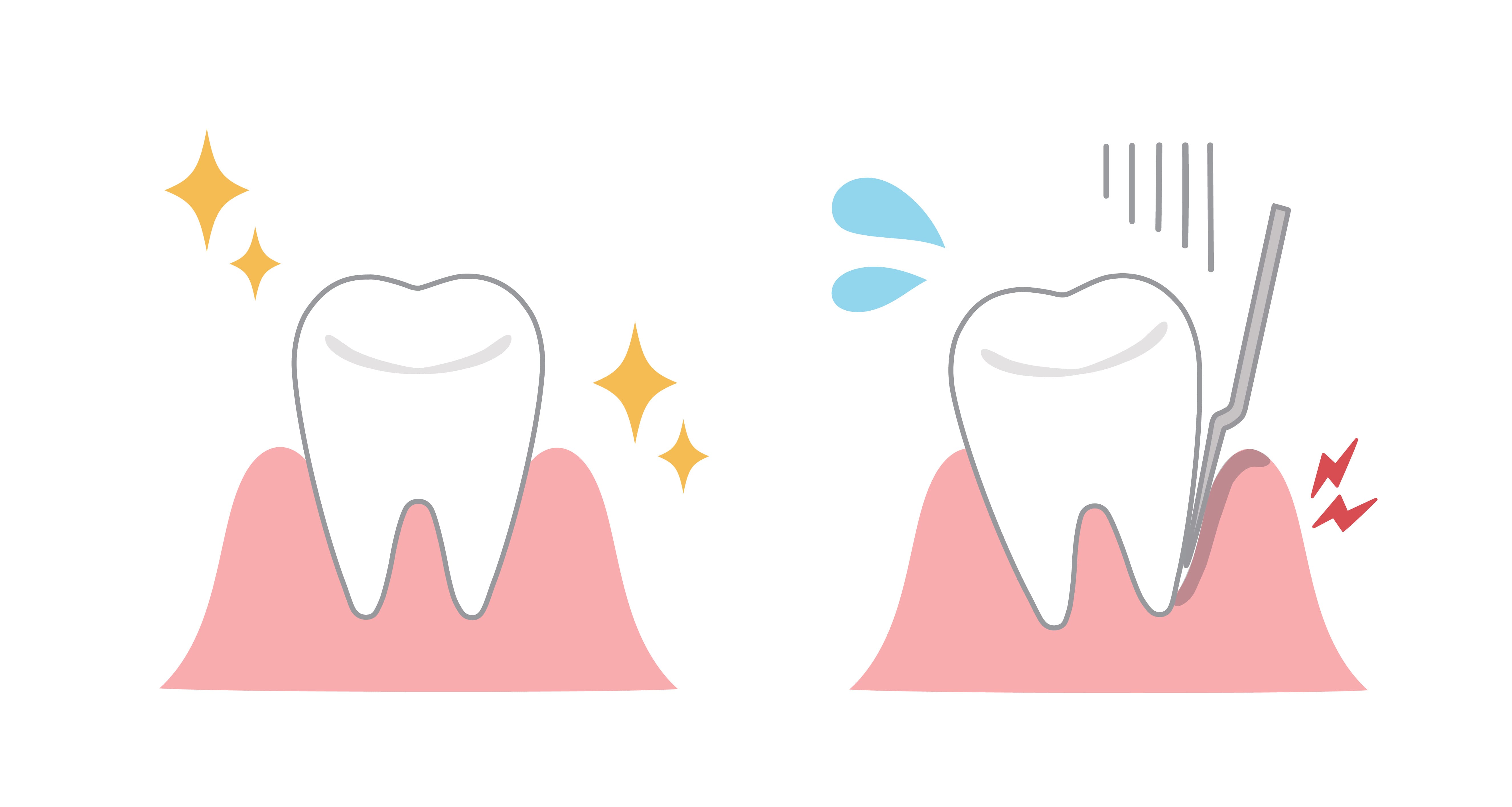 caries