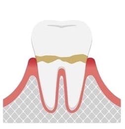 caries