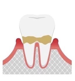 caries