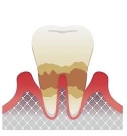 caries