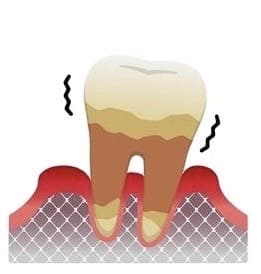 caries