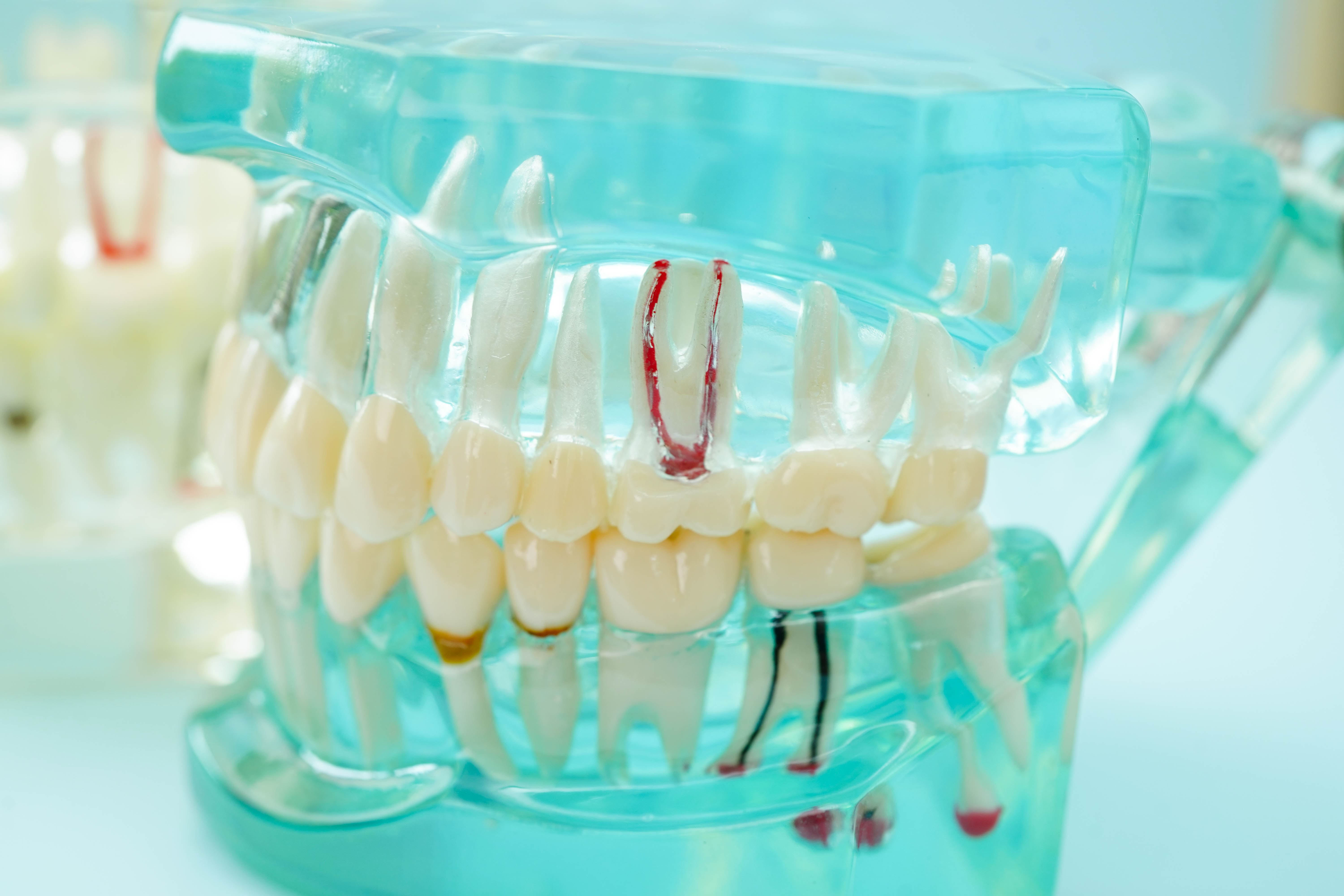 caries