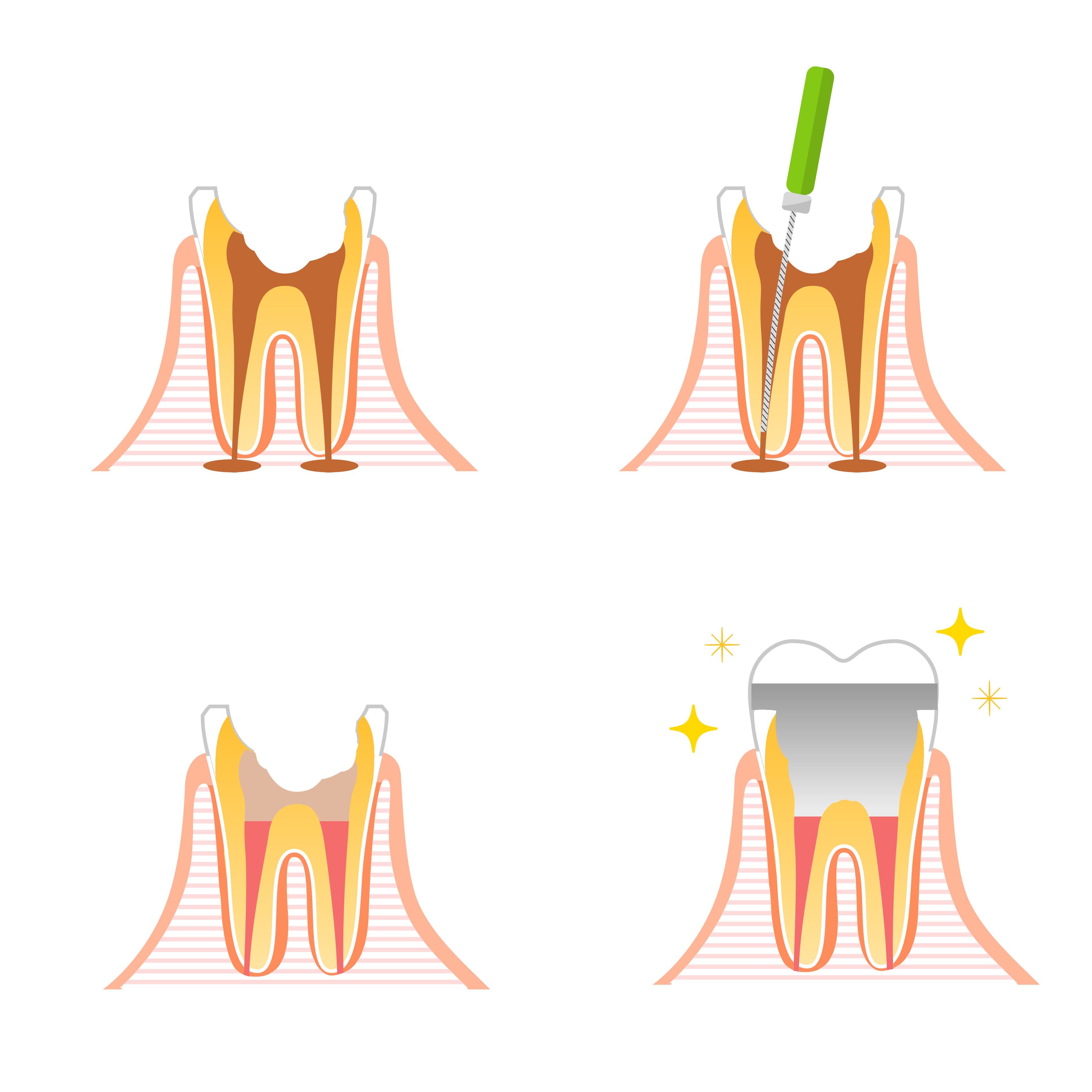 caries